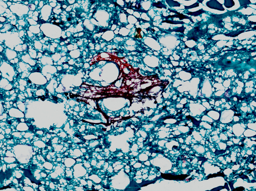Das Bild zeigt die fotografische Aufnahme eines Mikroskopbildes in 20-facher Vergrößerung. Es handelt sich um einen histologischen Schnitt von einer Brühwurst (Regensburger), die einen Partikel von einer wieder verarbeiteten Brühwurst enthält. Das Brät der Regensburger wird im histologischen Schnitt in türkisblauer Farbe dargestellt und weist eine schwammartige Struktur mit zahlreichen, unterschiedlich großen Hohlräumen auf, wobei es sich um ein Proteingerüst aus koaguliertem Muskeleiweiß und darin enthaltenen, winzigen Luftbläschen handelt. Das Brät der wieder verarbeiteten Brühwurst hat ebenfalls eine schwammige Struktur, färbt sich jedoch rot an. Durch das spezielle Färbeverfahren werden Rauchkondensate enthaltende Teile einer wieder verarbeiteten Brühwurst (Wursthülle und direkt darunter liegendes Wurstbrät) rot gefärbt. Der histologische Schnitt wurde mittels eines Gefriermikrotoms (Schneidegerät zur Herstellung hauchdünner Flächenschnitte) von einem Stück Brühwurst abgeschnitten, auf ein Objektträgerglas aufgezogen, fixiert und mit einem speziellen Färbeverfahren nach Charvát gefärbt. Ein üblicher Schnitt in der Lebensmittelhistologie hat ungefähr eine Fläche von 2 x 2 cm und eine Dicke von etwa 10 μm (ca. 1 hundertstel mm).
